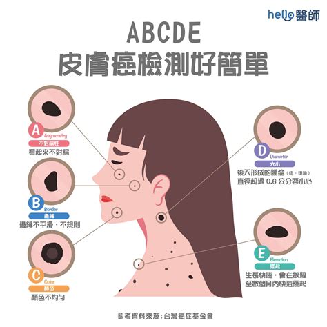 容易長痣|健康網》長痣＝皮膚癌？ 醫提7症狀：善用ABCDE原。